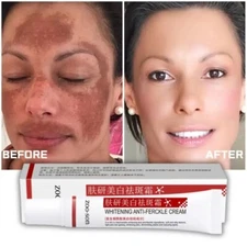 Powerful Spot-removing Whiten Cream Pigmentation Melasma Dark Spots