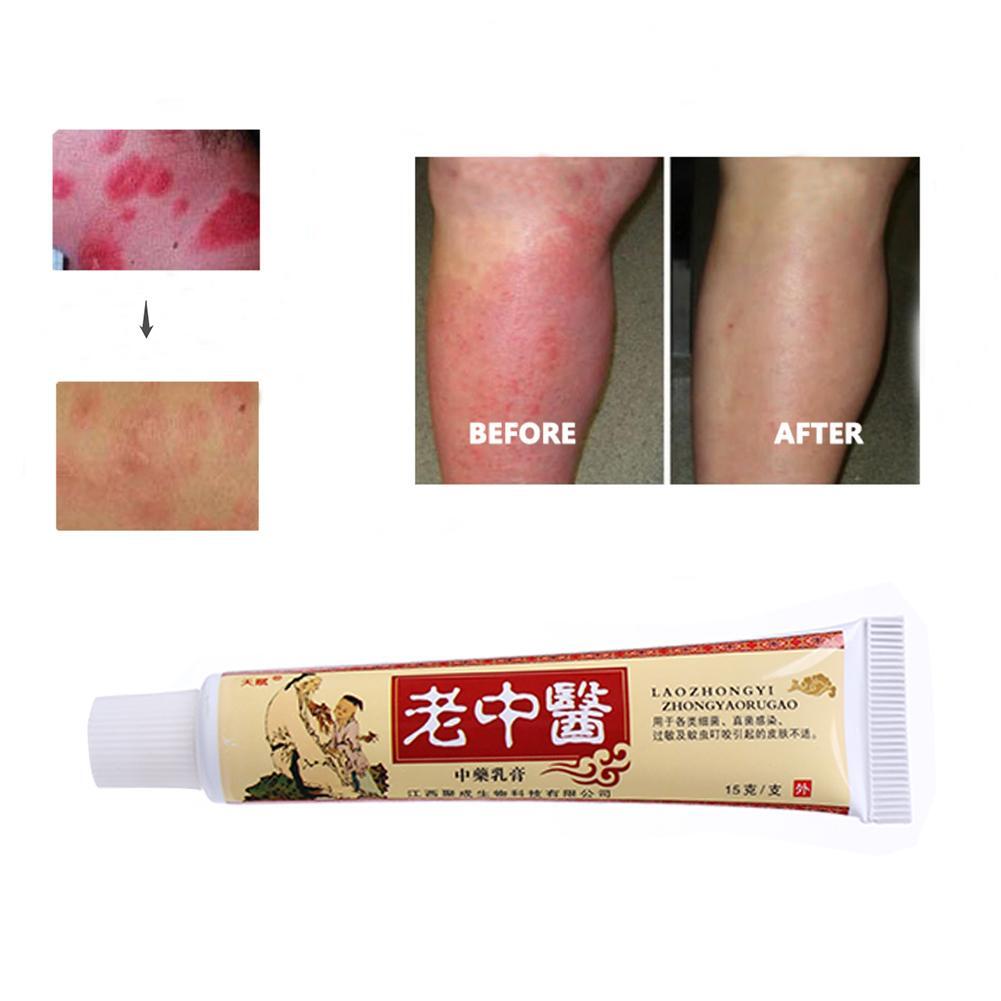 1pc 15g Skin Psoriasis Cream Dermatitis Eczematoid Eczema Ointment