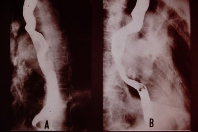 No Date Medical Slide X-Ray Mass Produced  Slide CD-L
