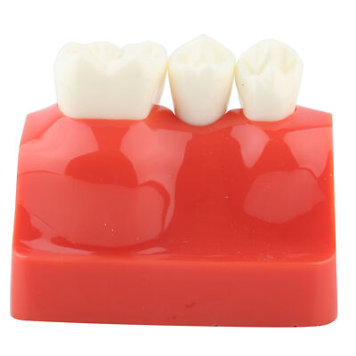 Dentist Resin Dental Demonstration Tooth Model Implant Analysis Crown Bridge