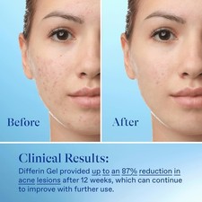 Acne Treatment Gel, 30 Day Supply, Retinoid Treatment for Face with 0.1 Adapale