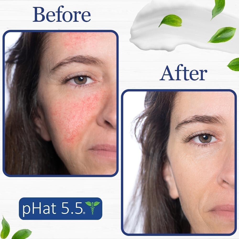 Seborrheic Dermatitis Cream with Manuka Honey, Coconut Oil and Aloe