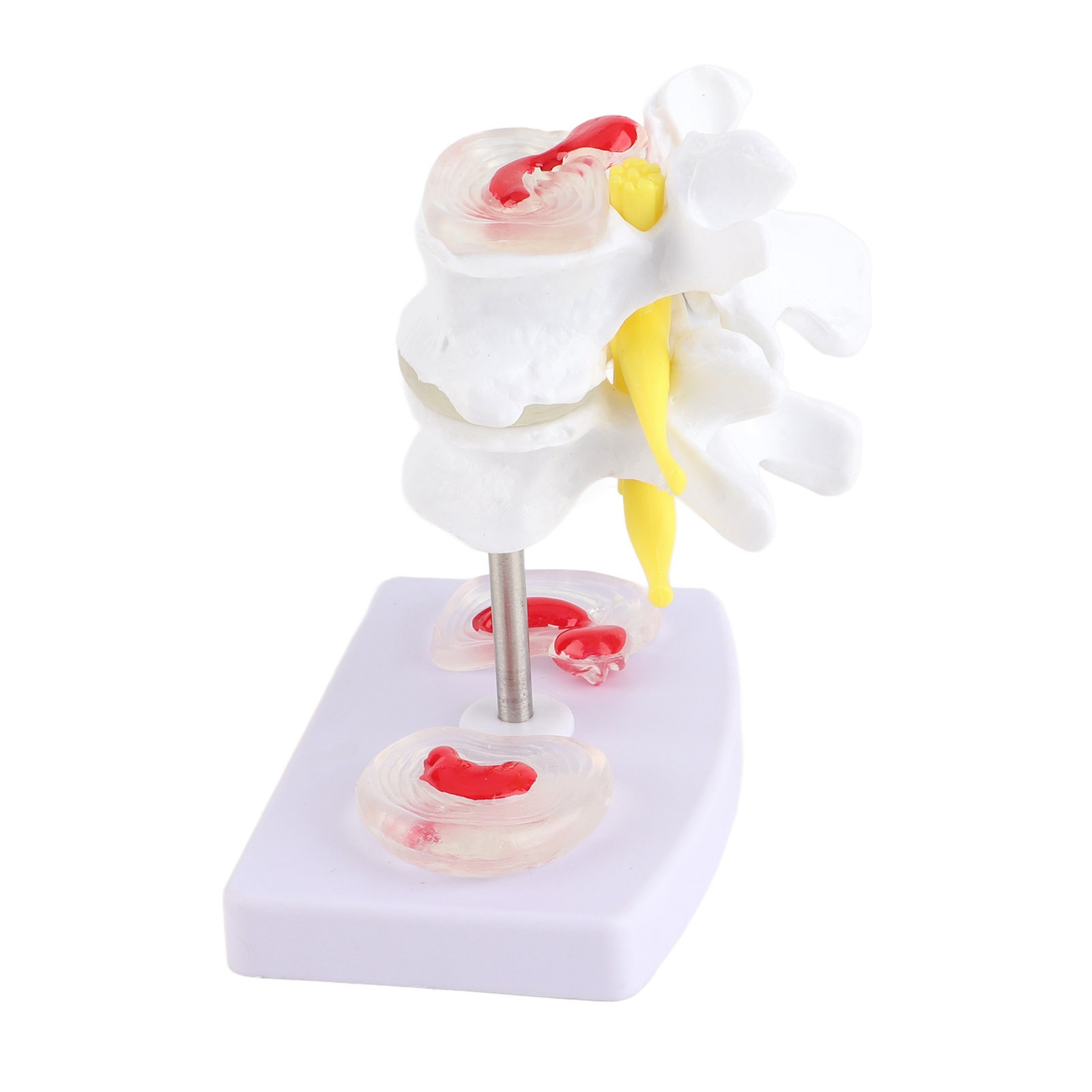 NEW Anatomical Lumbar Disc Herniation Demonstration Model Human Spine School Tra