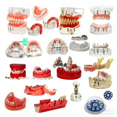 Dental Implant Model Upper Lower Jaw Demo All on 4/6 Overdenture treatment model