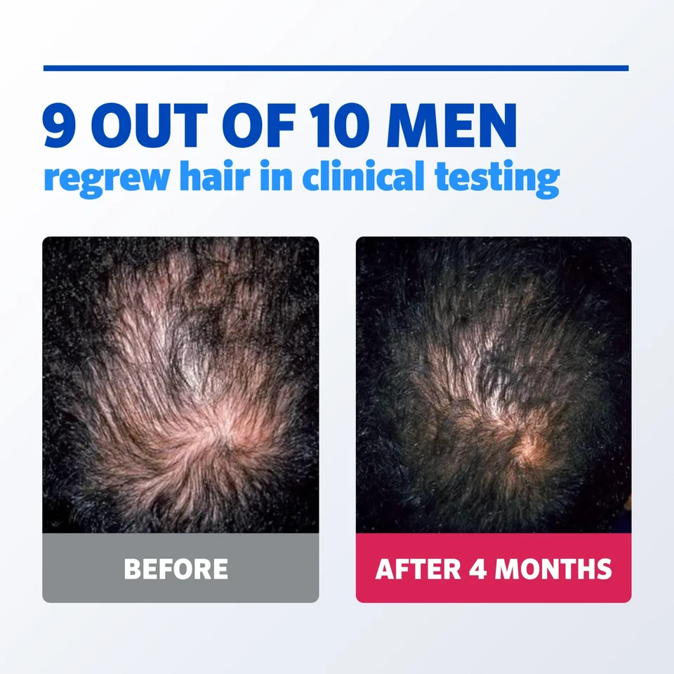 ✳️✳️🔥 Kirkland Minoxidil 5% Hair Regrowth Treatment AUTHENTIC Exp 03/2027 ✳️ - Image 4 of 4