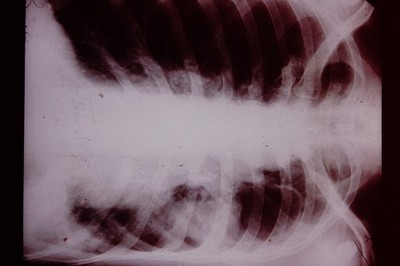 No Date Medical Slide X-Ray Mass Produced  Slide CD-K