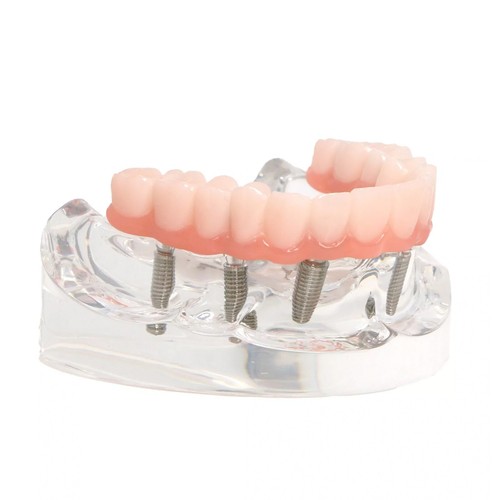 US Dental Overdenture Restoration Teeth Model With 4/6 Screws Upper/Lower Jaw - Picture 41 of 56