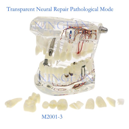 Modelo de implante y restauración de tipodonte dental modelo de demostración práctica de dientes modelo de tipodonte - Imagen 38 de 61