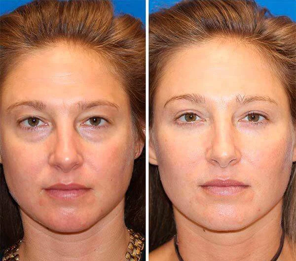 SKIN LIFTER Crema Viso Antirughe Antiage Idratante Rassodante Lifting ORIGINALE - Immagine 4 di 4