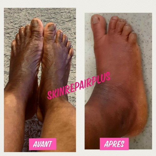 Crème SOIN Effaceur d'hyperpigmentation pour phalanges, pieds - Zdjęcie 14 z 17