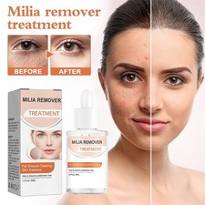 Milia Remover Treatment Milia Spot Removal Serum For Face Helps to Ruduce Milia