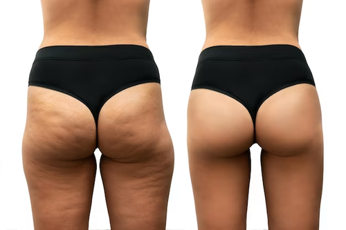 2x1 Glutei Fit Crema Rassodante Cosce Glutei Rimodellante Tonificante ORIGINALE - Foto 6 di 8