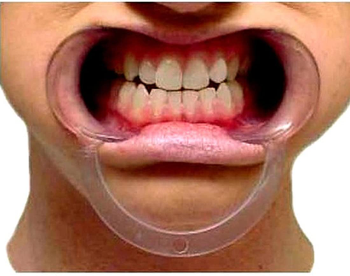 20 Pack M Size Dental Cheek Retractor - Picture 12 of 12