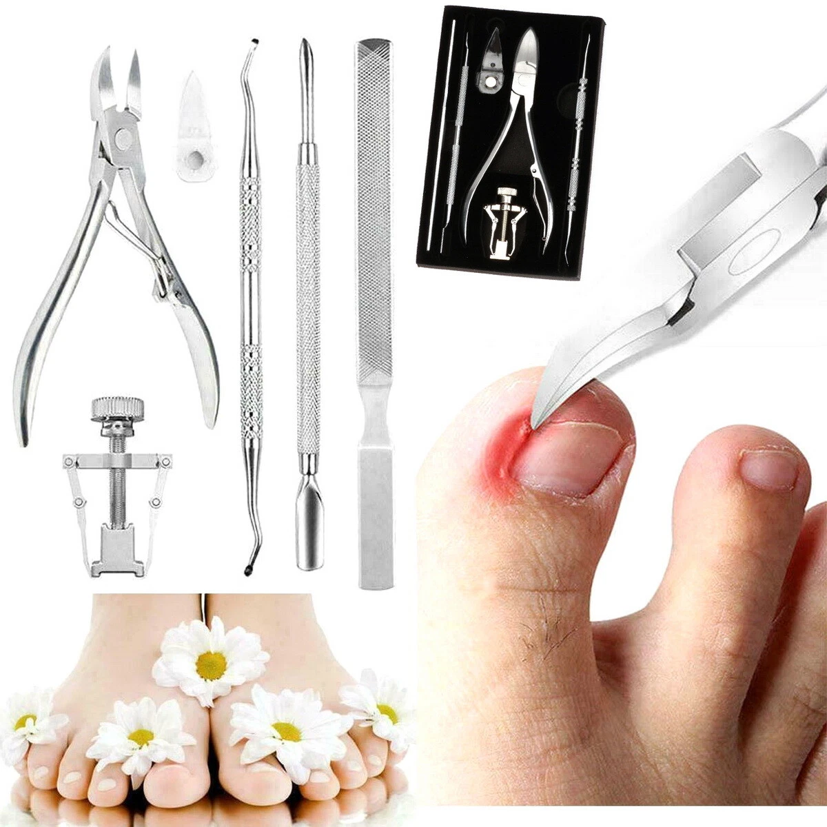 Ingrown toenail kit deals