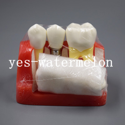 Implante Dental 3d Render Dientes | Foto Premium
