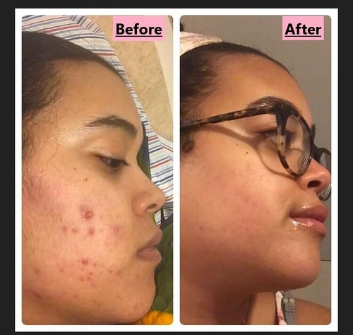 Jabón facial para acné - Limpiador diario para piel grasa - Barra de jabón hecha a mano [4 OZ] - Imagen 5 de 5