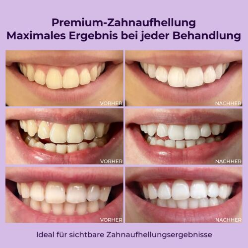 Onlysmile Gel Blanqueador de Dientes Blancos | Gel Blanqueador con Efecto Inmediato - Imagen 3 de 7