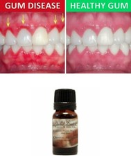 GINGIVITIS TREATMENT OIL | Mouthwash Bad Breath Gum Disease Receding Gums