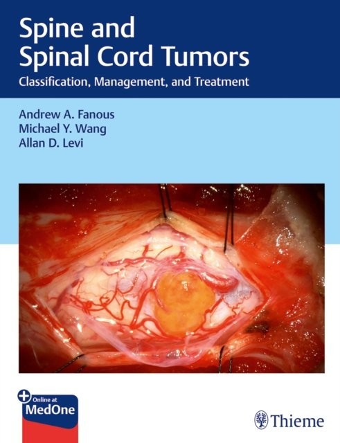 Spine and Spinal Cord Tumors – Classification, Management and Treatment Fanous