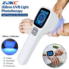 Zjkc 308nm Excimer System Blue Light Therapy Lamp Uvb Device for Skin Disorders