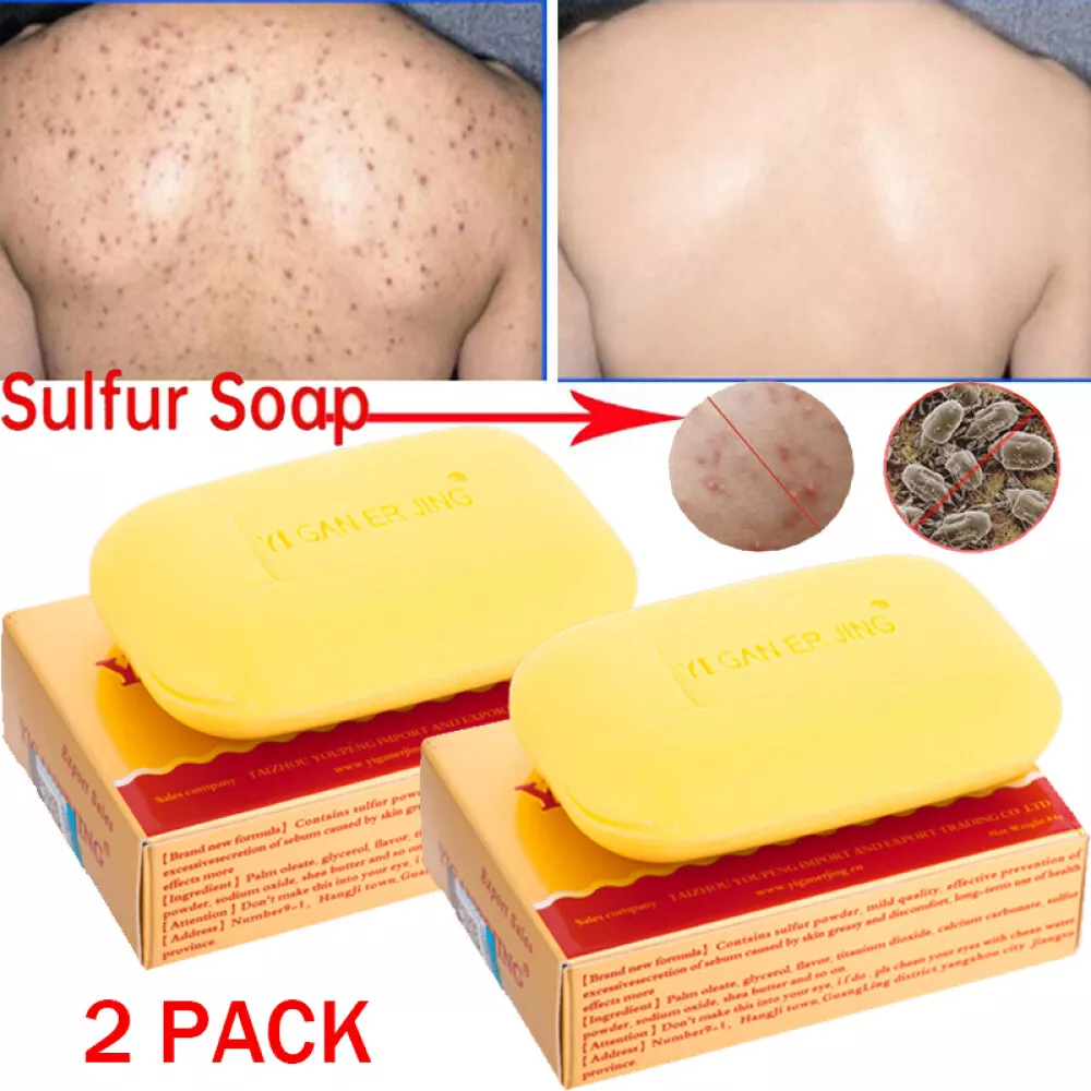 Fungal acne soap deals
