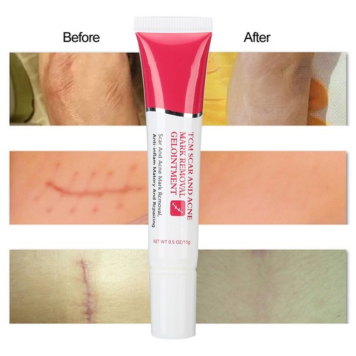 TYJR Scar Removal Cream Face Body Repair Gel Skin Repair Dark Spot Cream 15 AU - Picture 9 of 12