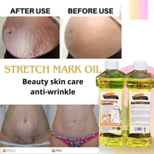  Stretch Marks & Scars Oil – 100% Natural, 600ml 