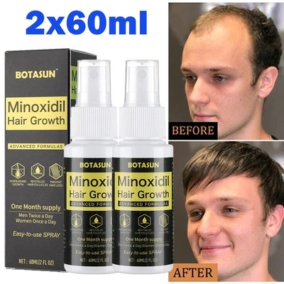 BOTASUN 2 Pack 5% Minoxidil Hair Growth Serum Spray for Men Healthier and Thicker Hair