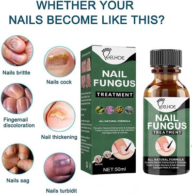 BEST Fungal Nail Treatment Liquid HIGHLY EFFECTIVE KILLS TOE NAIL FUNGUS