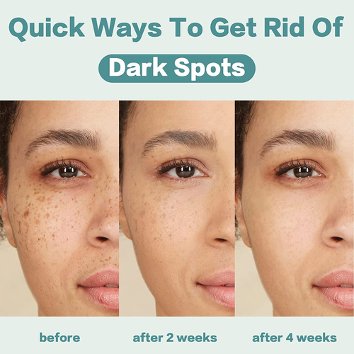 Dark Spot Remover Face Cream Natural Lightning Freckle Marks Corrector 1.7 fl Oz - Picture 4 of 9