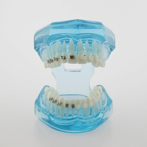Dental Orthodontic Teeth Study Model with Metal Ceramic Bracket Braces 3003 - Picture 26 of 33