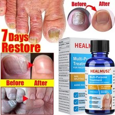 HEALMUSZS Athletes Foot NAIL FUNGUS TOENAIL Foot Care support FOR NAILS 30mls