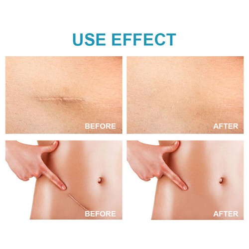 Scar Removal Cream New Old Scars Surgery, Stretch Marks Acne Pigmentation - Picture 8 of 11