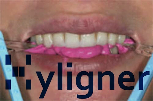 Straight your teeth, Hybrid and Clear aligners. UPPER or LOWER ONLY - Image 3 of 4
