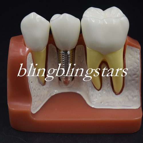 Dental Implant Demonstration Teeth Model Analysis Crown Bridge for Dentist 4 Tim - 第 9/9 張圖片