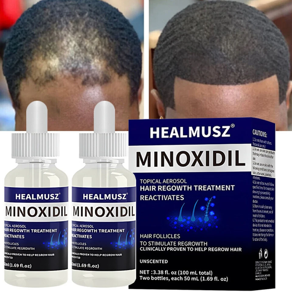 Paquete de 6 | Minoxidil 5% Extra Fuerza Hombres Tratamiento de Regeneración del Cabello Suministro para 4 Meses Foto 2 de 4