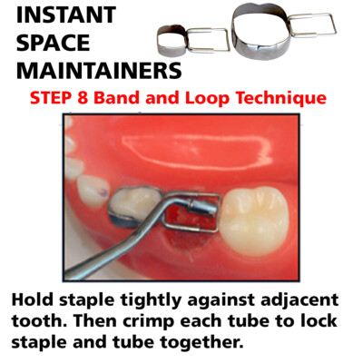 A unilateral band-and-loop space maintainer was placed to preserve