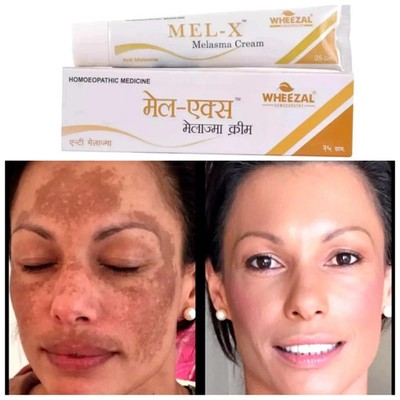 Wheezal Mel-X Melasma Cream (25g) for skin pigmentation like melasma, chloasma