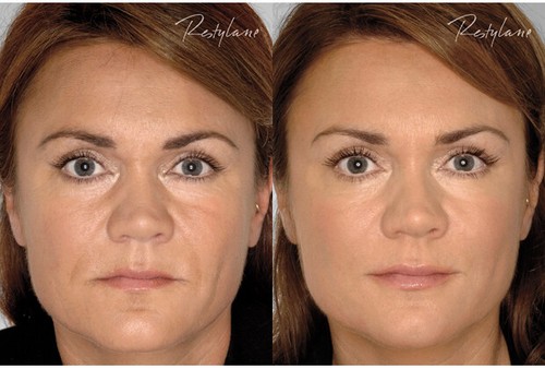 Phytoceramides Capsules Anti-Aging Product for Women & Men A Wrinkle Remover! - Picture 7 of 11