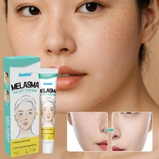 Freckle Removal Cream Whitening Anti Melasma Removal and Dark Spots Cream A T5Y1