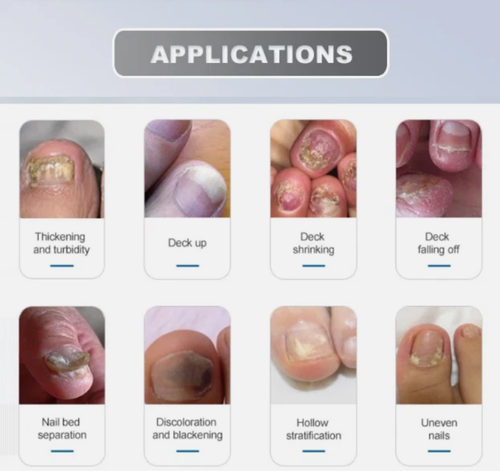 LASTEK 905nm Laser Nagelpilz Behandlung Gerät für Zehennagel & Fingernagel Gesundheit - Bild 5 von 8