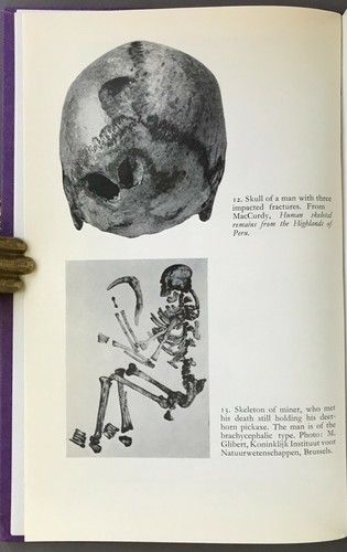 First UK Edition w/ DJ Paul A. Janssens Palaeopathology John Baker 1970 - Picture 7 of 12