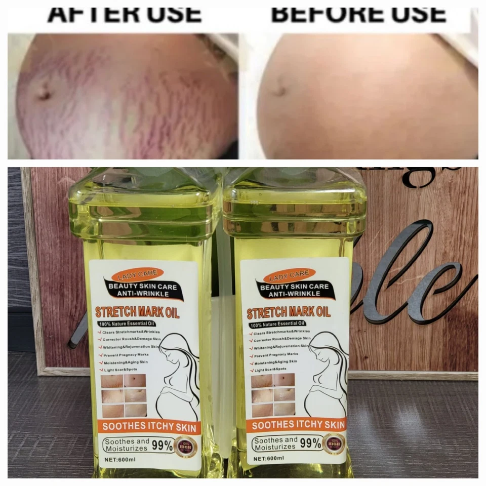 Aceite para estrías y cicatrices - 100 % natural, 600 ml Foto 2 de 3