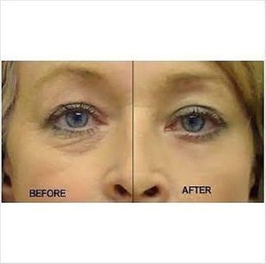 best eye wrinkle remover