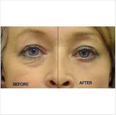 best under eye bag remover