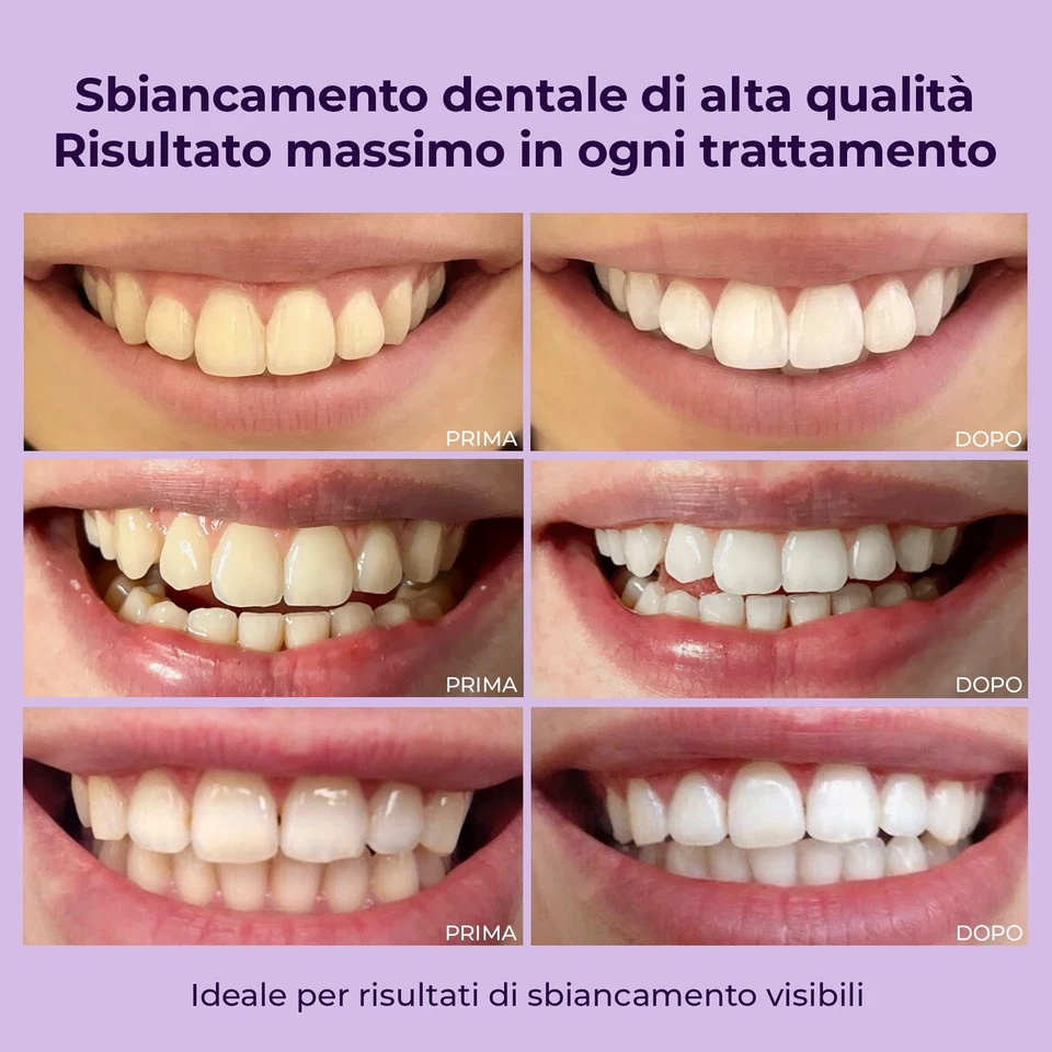 Gel sbiancante per denti professionale OnlySmile | Sicuro e indolore - Image 3 of 4