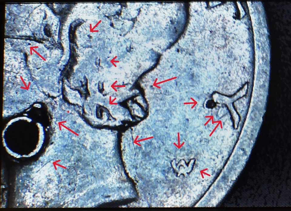 1929 Silver Mercury Dime with Rare Errors Blowholes, Die Cracks, Cuds - Image 3 of 4