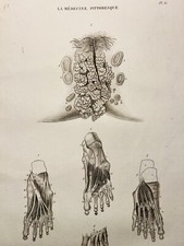Tavolo antico in rame 1834 malattie sessuali sifilide anatomia ulcera
