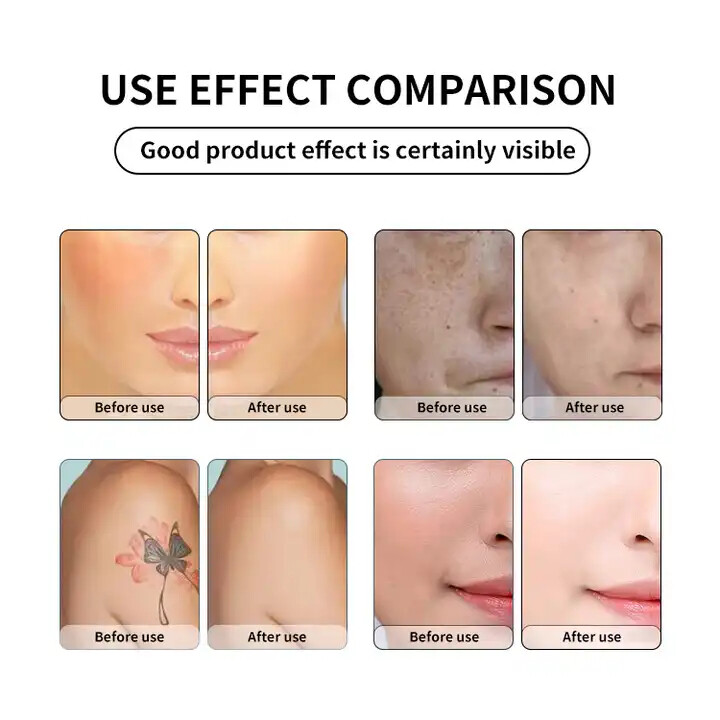 Picosecond Laser Tattoo Removal ND YAG Q Switch Laser Eyebrow Removal Machine