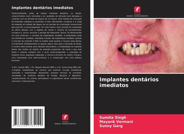 Implantes DentáRios Imediatos Sumita Singh (U. A.) Taschenbuch Portugiesisch-image